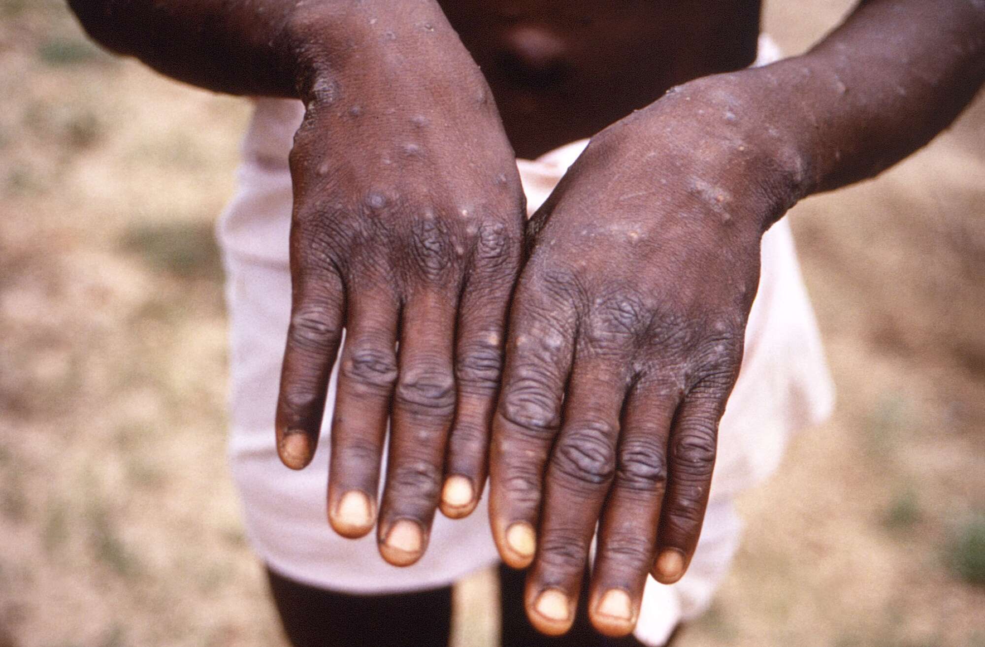 SECOND CASE OF IMPOX HAS BEEN CONFIRMED.